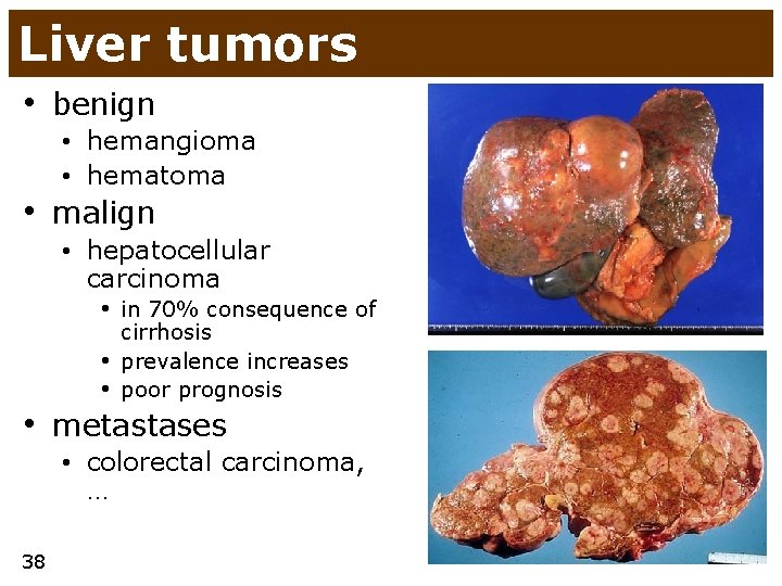 Liver tumors • benign • hemangioma • hematoma • malign • hepatocellular carcinoma •