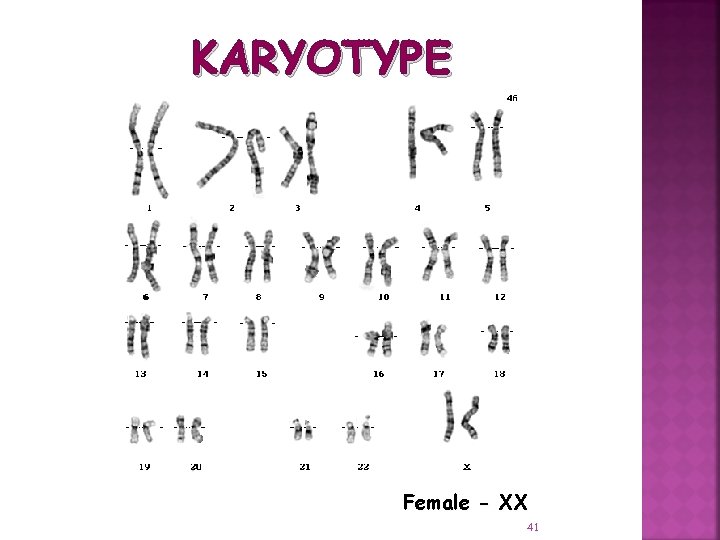 KARYOTYPE Female - XX 41 