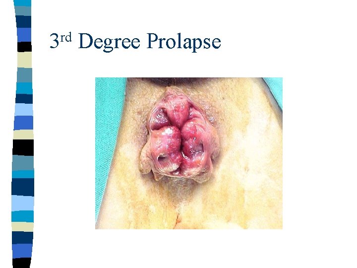 rd 3 Degree Prolapse 