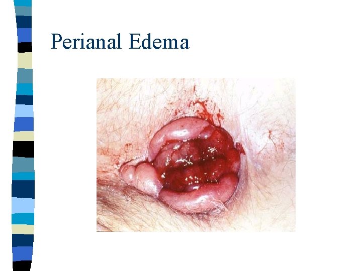 Perianal Edema 