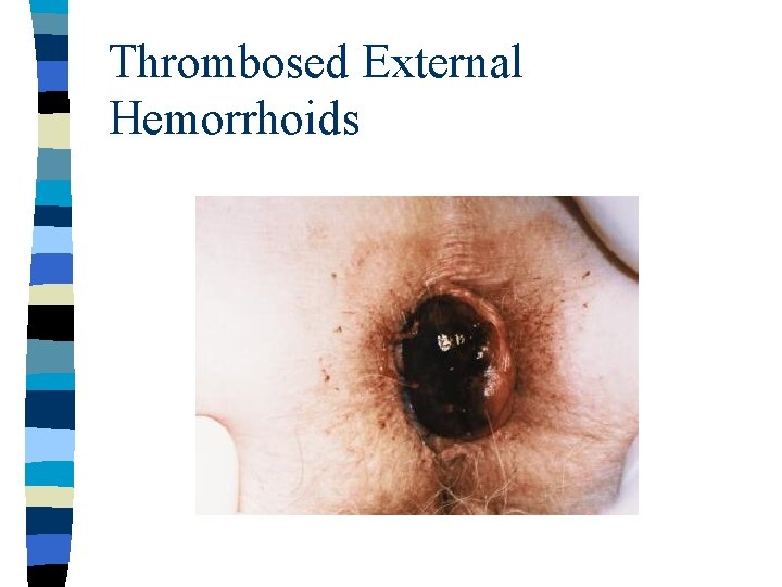 Thrombosed External Hemorrhoids 
