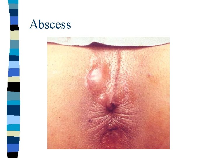 Abscess 