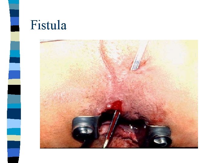 Fistula 