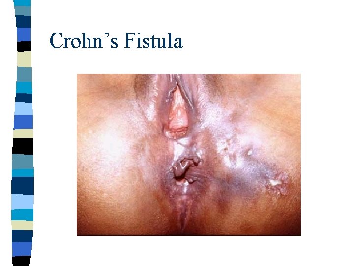 Crohn’s Fistula 