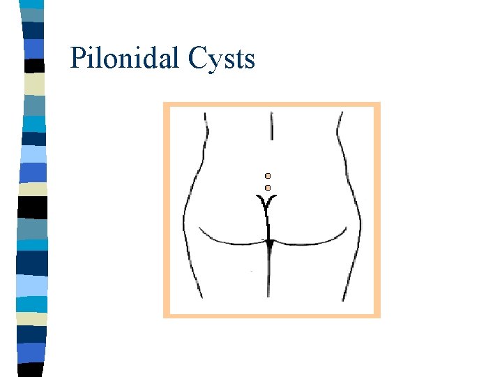 Pilonidal Cysts 