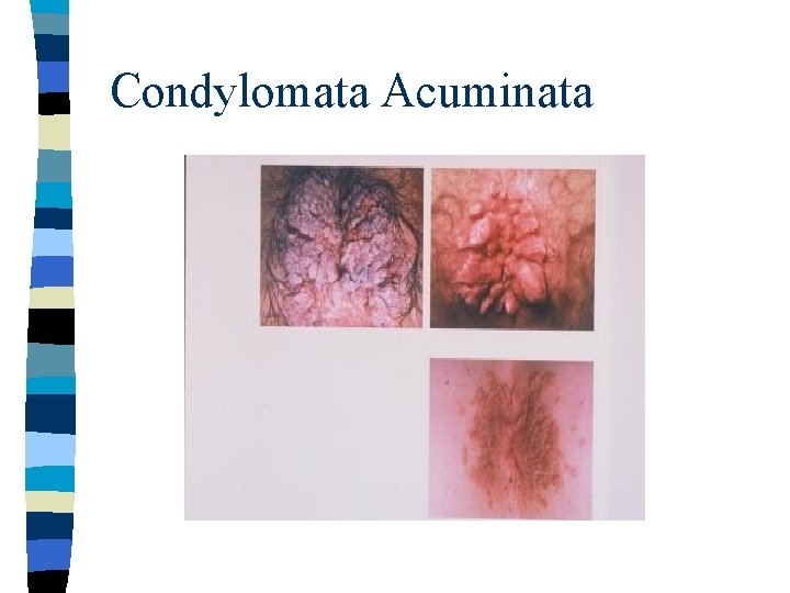 Condylomata Acuminata 