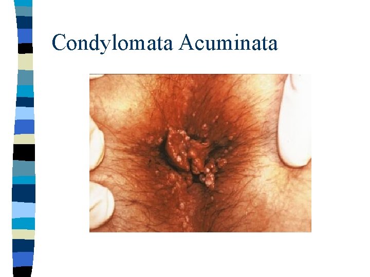 Condylomata Acuminata 
