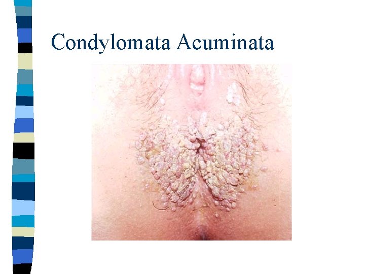 Condylomata Acuminata 