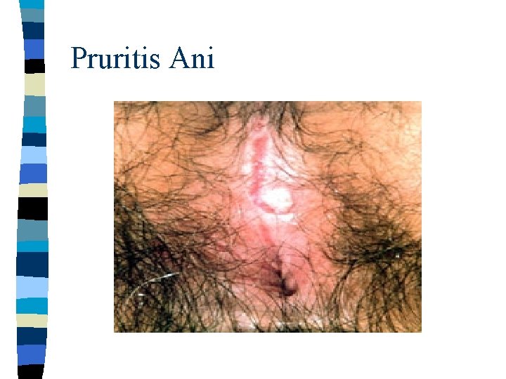 Pruritis Ani 