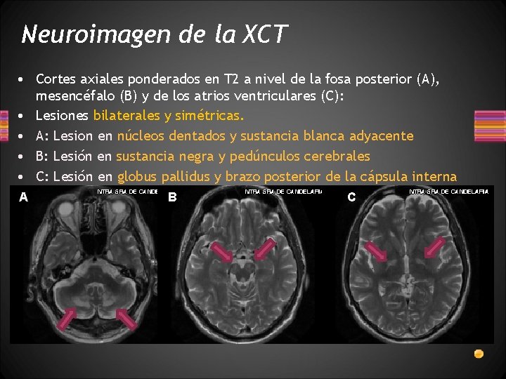 Neuroimagen de la XCT • Cortes axiales ponderados en T 2 a nivel de