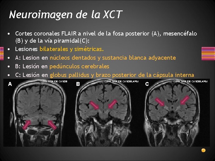 Neuroimagen de la XCT • Cortes coronales FLAIR a nivel de la fosa posterior