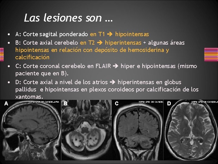 Las lesiones son … • A: Corte sagital ponderado en T 1 hipointensas •