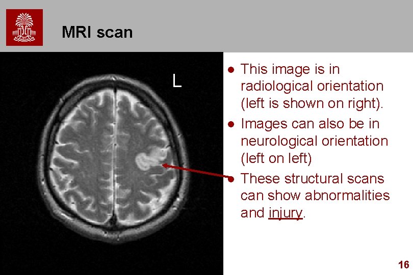 MRI scan L l l l This image is in radiological orientation (left is