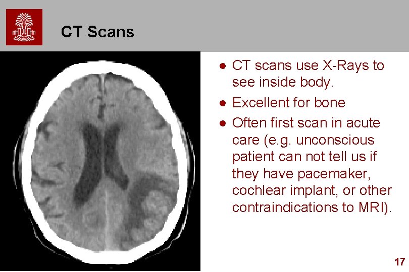 CT Scans l l l CT scans use X-Rays to see inside body. Excellent