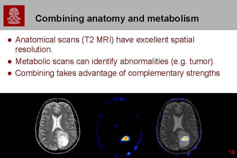 Combining anatomy and metabolism l l l Anatomical scans (T 2 MRI) have excellent