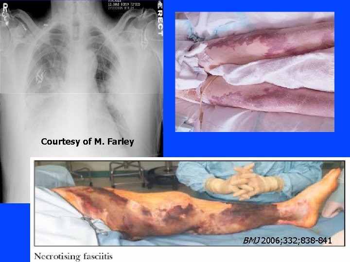 Courtesy of M. Farley BMJ 2006; 332; 838 -841 