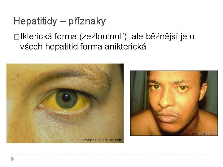 Hepatitidy – příznaky �Ikterická forma (zežloutnutí), ale běžnější je u všech hepatitid forma anikterická.