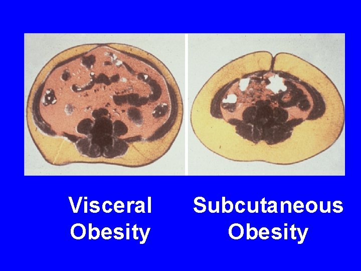 Visceral Obesity Subcutaneous Obesity Visceral Obesity Subcutaneous Obesity