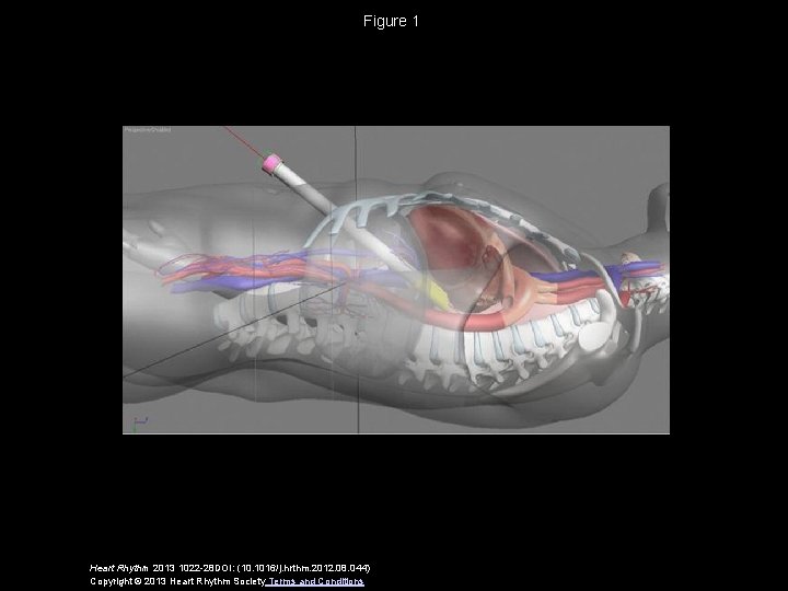 Figure 1 Heart Rhythm 2013 1022 -28 DOI: (10. 1016/j. hrthm. 2012. 08. 044)