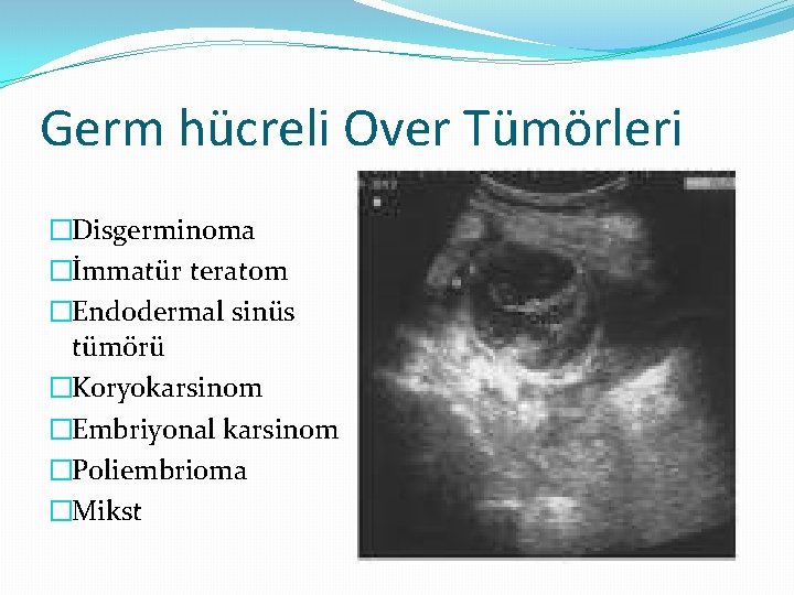 Germ hücreli Over Tümörleri �Disgerminoma �İmmatür teratom �Endodermal sinüs tümörü �Koryokarsinom �Embriyonal karsinom �Poliembrioma