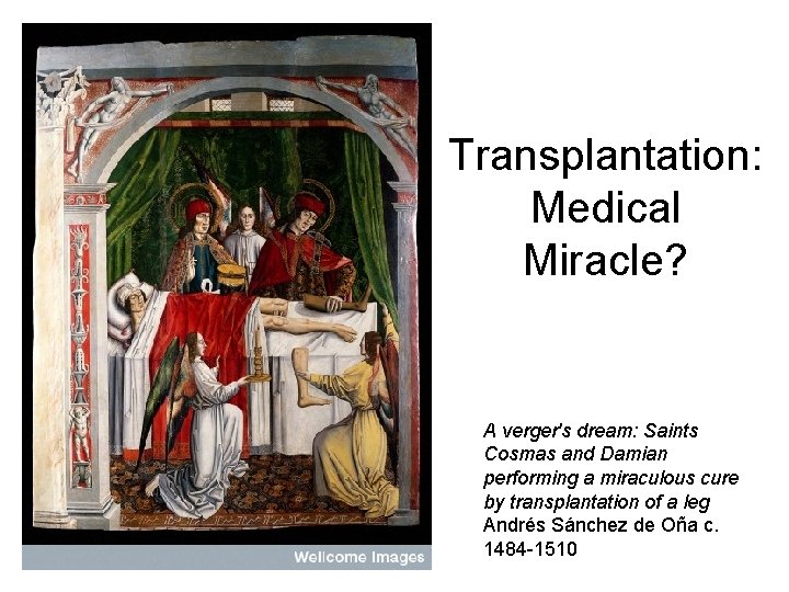 Transplantation: Medical Miracle? A verger's dream: Saints Cosmas and Damian performing a miraculous cure