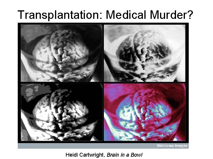 Transplantation: Medical Murder? Heidi Cartwright, Brain in a Bowl 