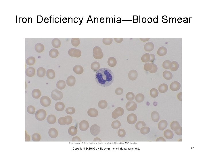 Iron Deficiency Anemia—Blood Smear Copyright © 2019 by Elsevier Inc. All rights reserved. 31