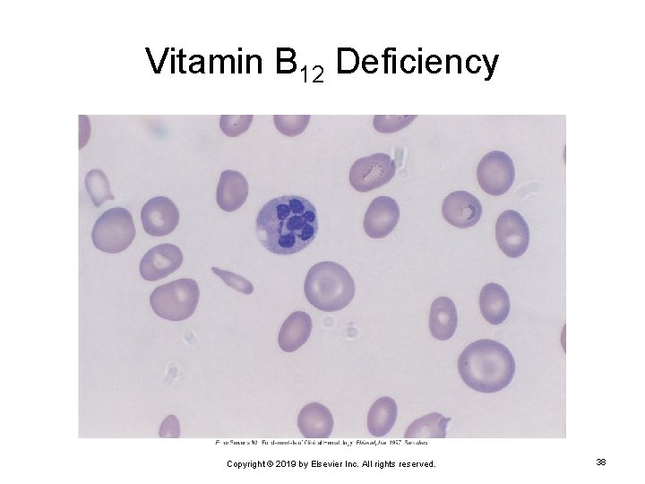 Vitamin B 12 Deficiency Copyright © 2019 by Elsevier Inc. All rights reserved. 38