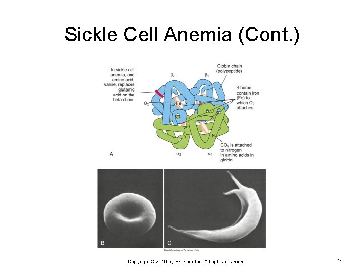 Sickle Cell Anemia (Cont. ) Copyright © 2019 by Elsevier Inc. All rights reserved.