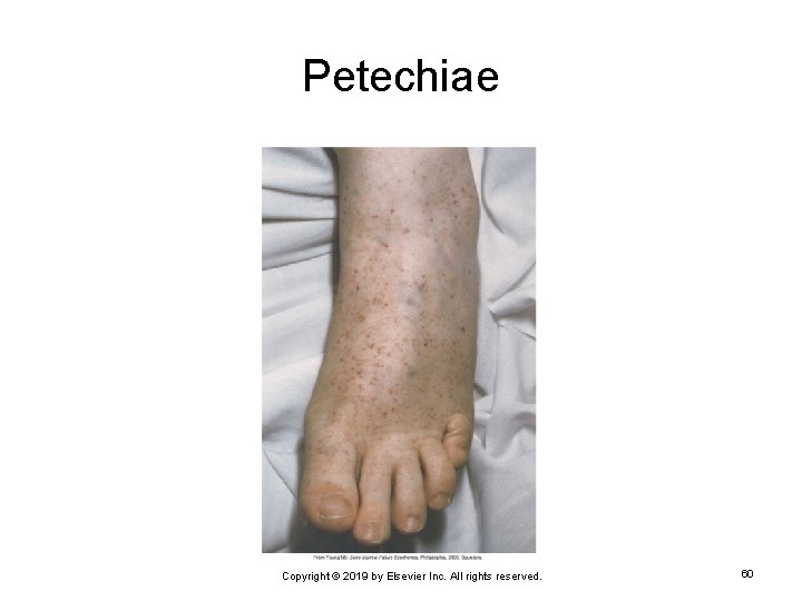 Petechiae Copyright © 2019 by Elsevier Inc. All rights reserved. 60 