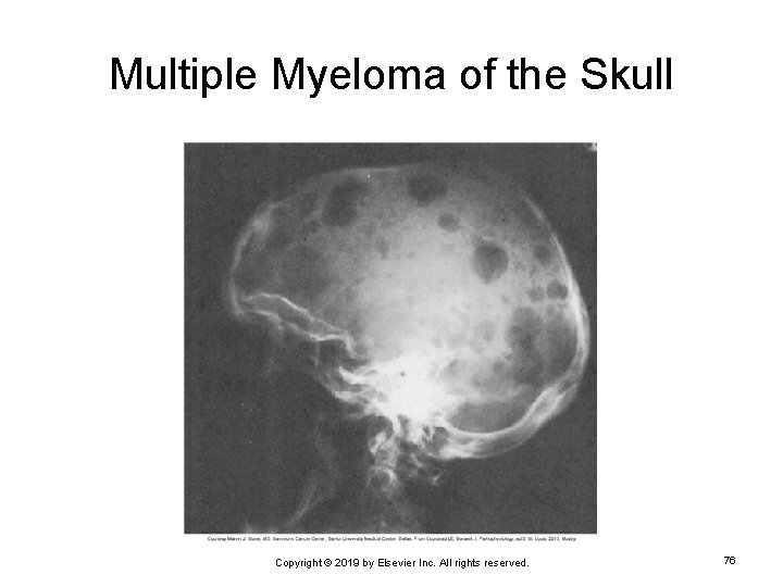 Multiple Myeloma of the Skull Copyright © 2019 by Elsevier Inc. All rights reserved.