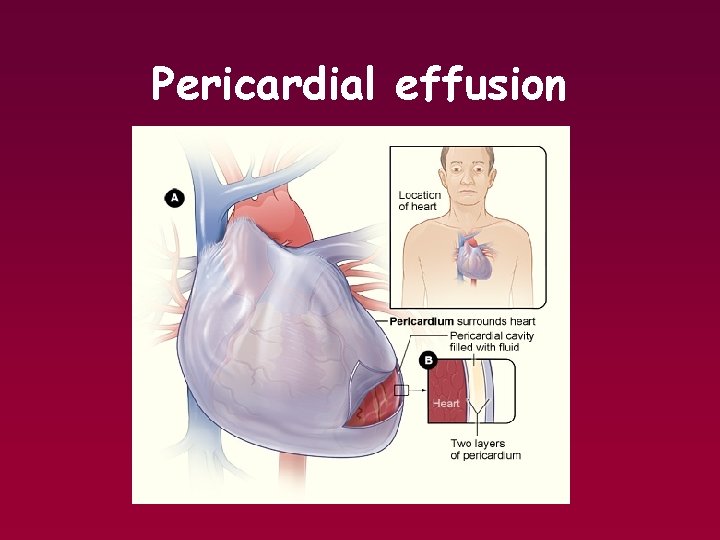 Pericardial effusion 