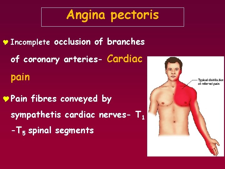 Angina pectoris Y Incomplete occlusion of branches of coronary arteries- Cardiac pain Y Pain