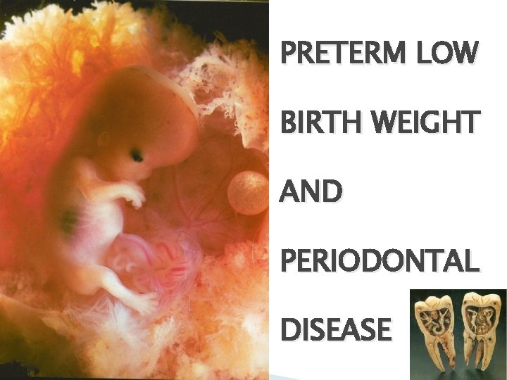 PRETERM LOW BIRTH WEIGHT AND PERIODONTAL DISEASE 