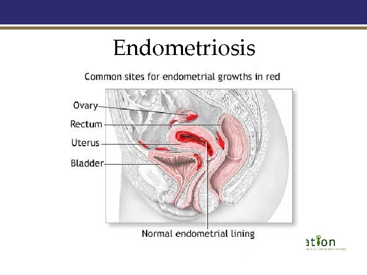 Endometriosis 