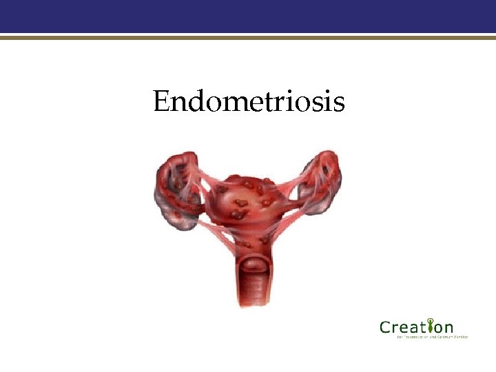 Endometriosis 