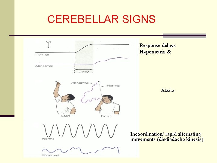 CEREBELLAR SIGNS Response delays Hypometria & Ataxia Incoordination/ rapid alternating movements (disdiadocho kinesia) 
