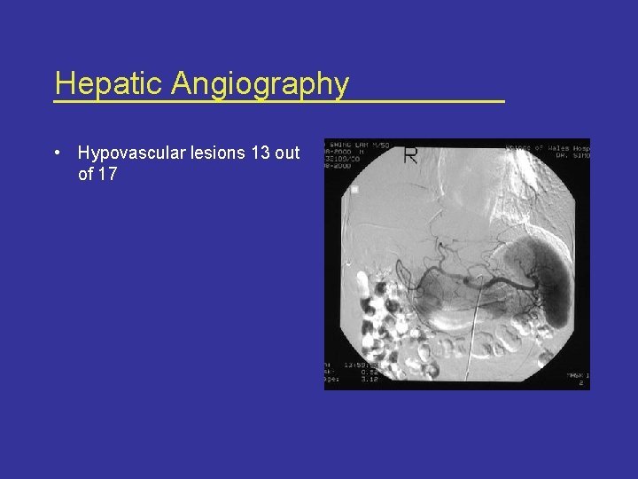 Hepatic Angiography • Hypovascular lesions 13 out of 17 