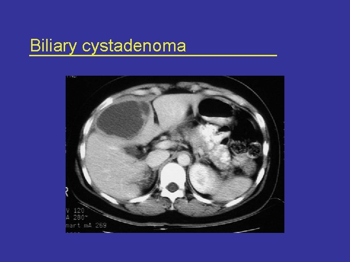 Biliary cystadenoma 