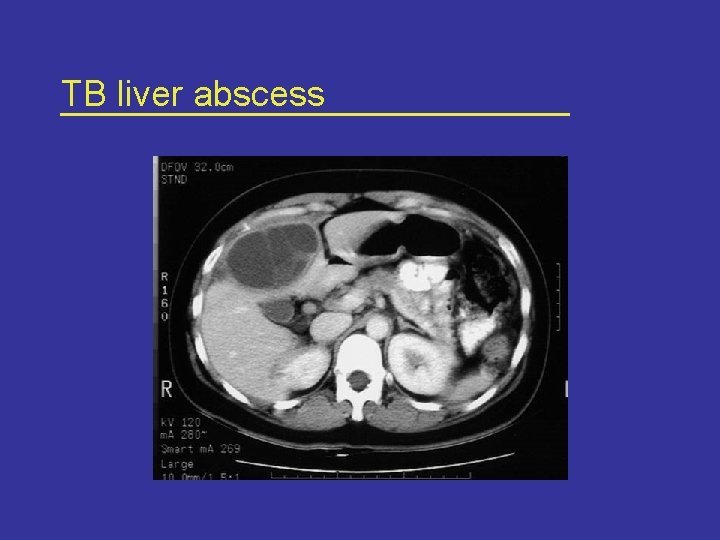 TB liver abscess 