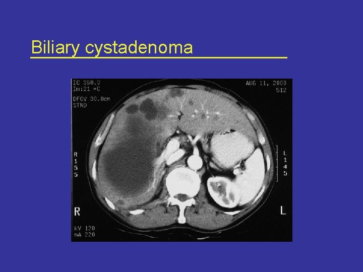 Biliary cystadenoma 