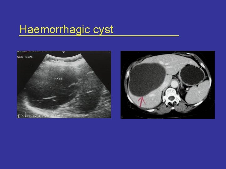 Haemorrhagic cyst 