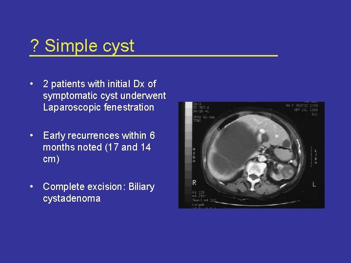 ? Simple cyst • 2 patients with initial Dx of symptomatic cyst underwent Laparoscopic