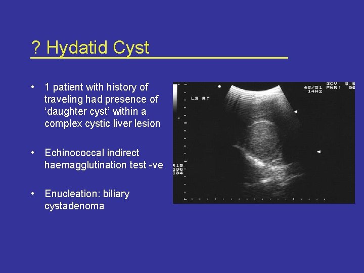 ? Hydatid Cyst • 1 patient with history of traveling had presence of ‘daughter