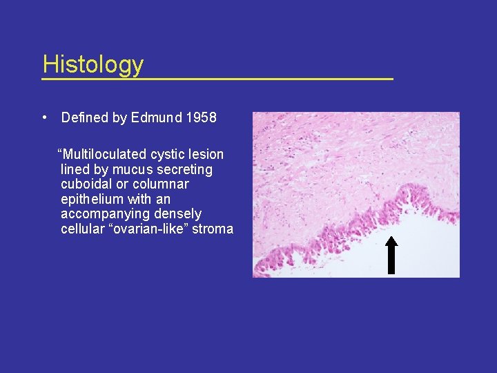 Histology • Defined by Edmund 1958 “Multiloculated cystic lesion lined by mucus secreting cuboidal