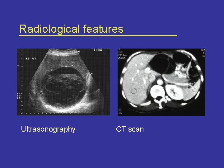 Radiological features Ultrasonography CT scan 
