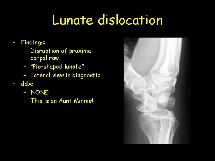 Lunate dislocation • Findings: – Disruption of proximal carpal row – “Pie-shaped lunate” –