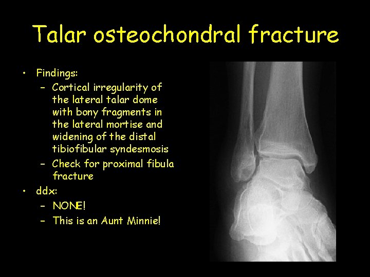 Talar osteochondral fracture • Findings: – Cortical irregularity of the lateral talar dome with