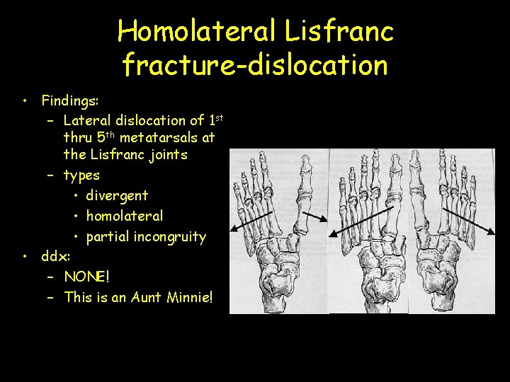 Homolateral Lisfranc fracture-dislocation • Findings: – Lateral dislocation of 1 st thru 5 th