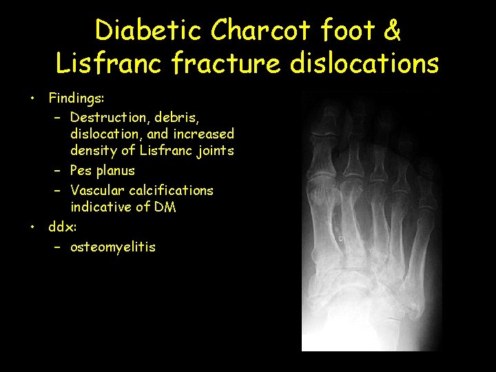 Diabetic Charcot foot & Lisfranc fracture dislocations • Findings: – Destruction, debris, dislocation, and